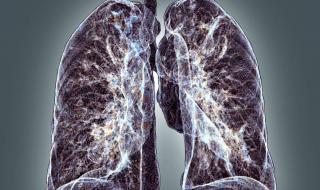 肺结核的主要传播途径